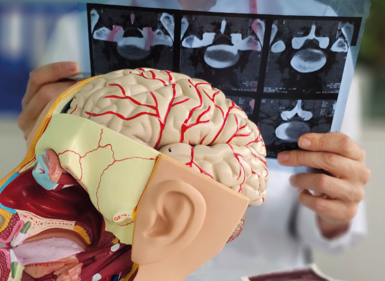 accidente cerebrovascular